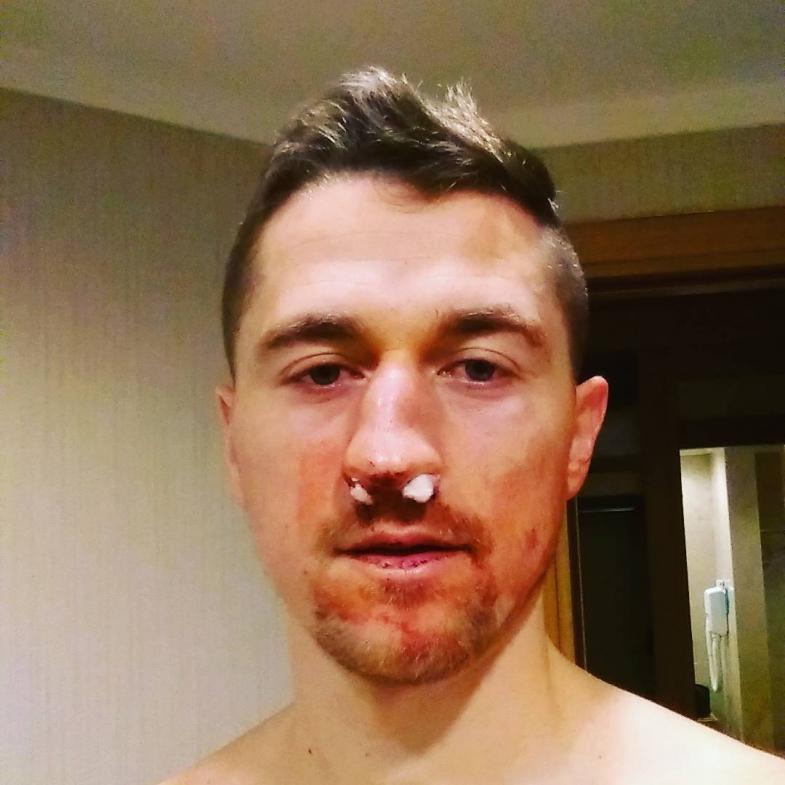 Футболист «Кайсара» показал видео ужасной травмы, полученной в матче с «Кайратом»